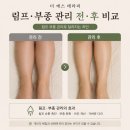 더 에스 테라피 | 경산 림프부종관리｜다리붓기 종아리부종 전후 비교 후기｜중산동 시지 신매