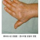 손가락 마디 통증 부음 휘어짐 염증 손가락 퇴행성 관절염 간단명료 알아보자 + 류마티스 차이 이미지