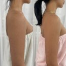 바디리핏 | 부산시청 바디온다리프팅 리핏 팔뚝 지흡 고민 끝!