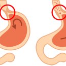 위가 안좋을때 증상, 위산이 역류하는 위식도 역류질환 이미지