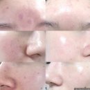 두달간 홈케어기기로 상한얼굴 복구[셀올MTS, 쿼드쎄라,메디큐브 울쎄라 딥샷,뷰앤디 얼굴관리기기,셀비...