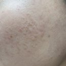 온바디한의원 | [흉터]온바디한의원, 내돈내산 6회차 후기, 새살침