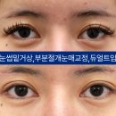 아이케이성형외과의원 네이버블로그