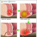 무한도전 노홍철의 '찌루찌루' 방치하기엔 너무 고통스러워 (치루사진有) 이미지