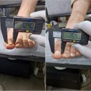 건강한장연합내과의원 | 종로 발톱무좀 전문 치료 감사한내과 레이저 관리 만족후기