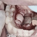 입안의 혹, 골융기 절제술로 제거한 사례 (잇몸 치조골성형술 후기)