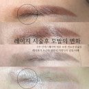 여기애가까운약국 | [에스테비비] 눈썹문신제거 1-7회차 후기_앰플리무버+레이저