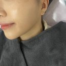 쁘띠케이의원 | [강남/신논현] 강남역 피부과 뉴케이의원 - 화이트닝 레이저 피코토닝, 이브 980 후기