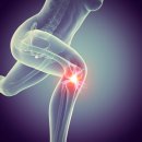홍제삼성본정형외과의원 | 홍제역 정형외과 러닝 후 무릎 통증이 심하다면