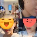 평택-평택-5 | 평택 여드름 PTT 내돈내산 후기(5회차 가격,통증)