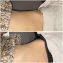 신사 바디관리 잘하는 제이윤뷰티, 복부 테라노바 후기