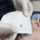 해맑은어린이집(승합차1) | 부산 8개월 아기 스킨텍제거 수술 후기 (포크랄시럽 국소마취) 비용 관리방법