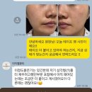 천안주근깨관리 이지엘뷰티 잡티리무버 후기 2탄