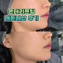 설레;봄 | 대구 온다리프팅 이중턱 고민 해결 후기 (ft.내돈내산 추천)