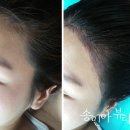 수정헤어라인 네이버블로그