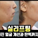 실리프팅, 효과가 이렇게 좋았나? 처진 얼굴살을 탄력있게! 이미지