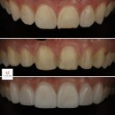 수정기공사 | 압구정 원데이 라미네이트, 하루 만에 끝난다고? 수치과병원에서 직접 확인했습니다
