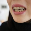 세정약국 | 인비절라인 클리덴트 치아교정기 세정폼 세척 효과 솔직 후기