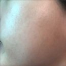 성인 볼 여드름 관리 후기 + 추천템