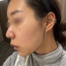 행복약국 | 서울 구리 편평사마귀 제거 성지 리터치 후기! 후관리 재생크림추천 (비립종, 점 무제한 19만 5천원)