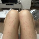 칠곡대학약국 | 급성두드러기 얼굴, 전신 주사 약 치료과정 후기