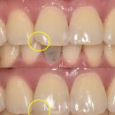 수복약국 | 원당치과|찌릿한 치통, 치아 파절! 이를 빼야할까요? 임플란트를 해야할까요?
