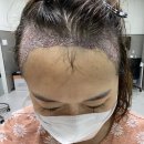 포헤어의원 | [압구정 포헤어의원/모발이식]포헤어 여성M자 수술후기(수술당일)