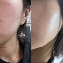 온누리한의원 | 안양 범계 여드름 관리 가로세로 한의원 _ 4회차 1달 후기 비포 애프터 내돈내산 후기