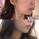 [강남] 강남역 피부과 인모드 후기 | 너무 만족해서 들고온 리뷰 .. ✨ | + 유명 토끼굴 정보