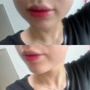부산 입술필러 리쥬란힐러 내돈내산 리얼 후기 (입술필러 내돈내산)