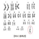 의학과한방(동영상):터너 증후군 (Turner Syndrome) 이미지