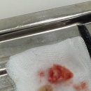 사랑담은치과의원 | 사랑이아프니치과의원 홍대점 사랑니 발치 후기(ft. 일요일 방문, 왼쪽 아래 사랑니, 지혈제, 타이레놀...