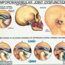 턱관절 장애(temporomandibular joint Disorder,TMJ) 2 이미지