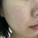 바비뷰 스킨 | 청담동피부과 압구정로데오역 청담피부과 리쥬란 다운타임 없이 받은 내돈내산 스킨부스터 후기