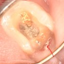시카고치과병원 | 산곡동 수면치과 | 누운 사랑니는 미루지 마세요 — 방치했다가 옆 치아까지 썩은 실제 진료 이야기