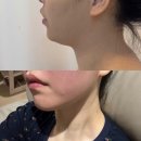 루아티뷰티 | 서산에스테틱 서산루아뷰티 이중턱 슬림젯 지방분해 관리 진짜 솔직후기!