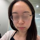 유앤아이의원 | [다산유앤아이의원] 점 20개 뺀 후기 내돈내산