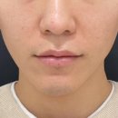 포톤테라피