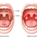 목부음 목젖 부었을때 원인 및 대처 이미지