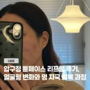 튠스타트 | 압구정 튠페이스 리프팅 후기, 얼굴형 변화와 멍 자국 회복 과정