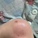 슬림약국 | 넥스케어 블레미쉬 패치 케어 | 올리브영 단독 초슬림 여드름패치 직접 써본 후기