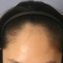 373 | [대다모 포토후기] 20대 여성 4500모 모발이식 373일 후기입니다.