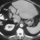 Agenesis of the right lobe 이미지