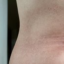 에이비한의원 | 에이비한의원 간의 만성염증(피부두드러기, 가려움 증세)한약치료후기