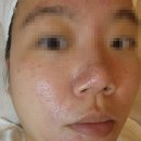 여드름케어전문 삼송 유빛에스테틱 관리 추천 후기