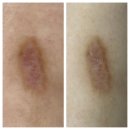 역시탑한의원 | 강남역 한의원 다리 패인흉터 치료 레이저 후기 (ft. 내돈내산)