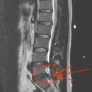 허리디스크치료사례-13 허*만님 26세/M 요추 4-5/요추5-천추1번간 추간판 탈출증 (치료전-후 MRI비교) 이미지