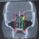 제주냐옹실 고양이미용 | [일상] 기능코 비중격만곡증 미용코 성형 후기(4주차, 수술 전/후 비교)