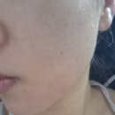 고우리 | 신사역피부과 콜라겐 스킨부스터 포텐자고우리 후기 피부탄력시술 추천