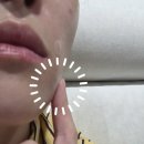 닥터홍스치과의원 | 불당동 닥터에버스 쥬베룩볼륨 4cc 받은 후기(feat.캐뉼라)